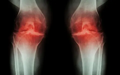 RTG kolan z zaznaczoną osteofitami i zwężeniem szpary stawowej, sugerujące chorobę zwyrodnieniową. Może być wskazana osteotomia podkolanowa.