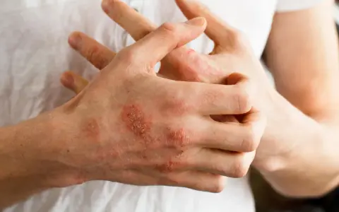Dłonie z widocznymi zmianami skórnymi, zaczerwienieniem i łuszczeniem, sugerującymi **przeczosy** lub inne schorzenie dermatologiczne.