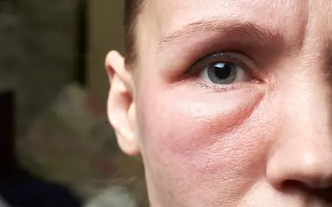 Un visage gonflé, peut-être un œdème, cherche un remède de grand-mère. Gros plan sur l'œil et la joue rougie.