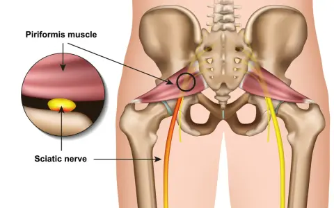 Illustration zeigt das Piriformis-Syndrom: Der Piriformis-Muskel drückt auf den Ischiasnerv.