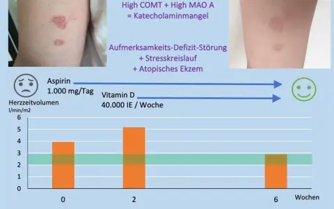 Vitamin D Mangel Symptome bei Erwachsenen: Erfahrungsberichte und Anzeichen