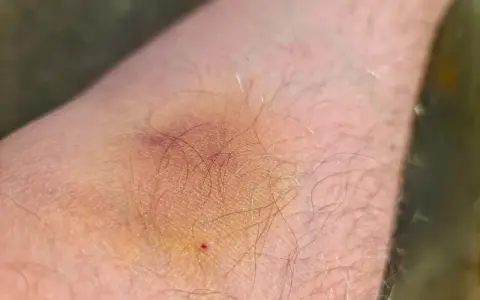Ein blauer Fleck auf der Haut, der leicht juckt. Die Haut ist leicht gerötet und von feinen Härchen bedeckt.