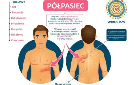Ilustracja przedstawia objawy półpaśca, w tym ból, pieczenie i wysypkę na ciele, wskazując na nietypowe objawy półpaśca.