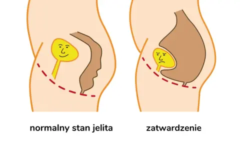 Normalne jelito z uśmiechniętą kupką vs. zatwardzenie z płaczącą kupką, co powoduje ból przy robieniu kupy.
