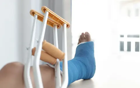 Noga w niebieskim gipsie, obok kul ortopedycznych. Diagnoza: złamanie kostki bocznej z przemieszczeniem.