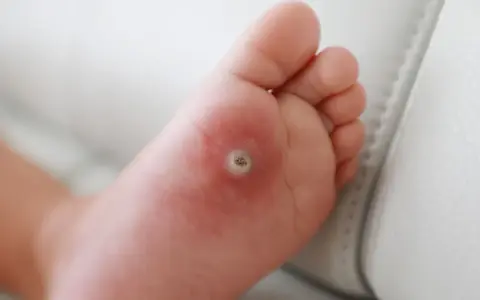 Dziecko ma kurzajkę na stopie, która jest widoczna na podeszwie.