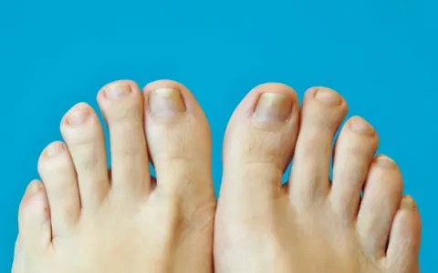 Gros plan sur des pieds montrant des ongles jaunis et épaissis, symptômes possibles de psoriasis ongle pied.