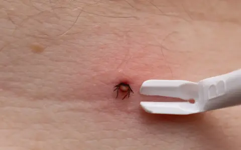 Zbliżenie na ludzką skórę z czerwonym zaczerwienieniem wokół wbitego kleszcza. Obok widoczny biały przyrząd do usuwania kleszczy.