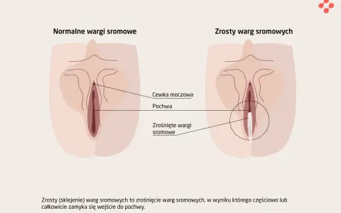 Ilustracja porównuje normalne wargi sromowe z zrośniętymi, które mogą wymagać operacji plastycznej pochwy.