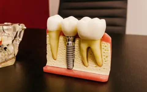 Model szczęki z zębami i mikroimplantem ortodontycznym. Implant zastępuje korzeń zęba, zapewniając stabilne podparcie dla korony.