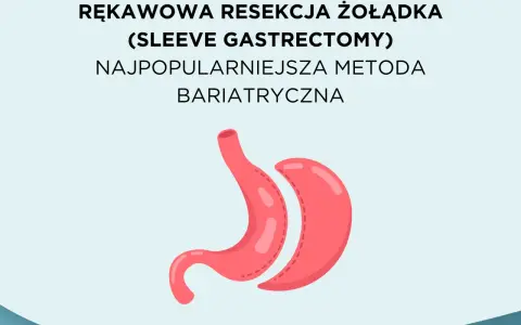 Rękawowa resekcja żołądka, najpopularniejsza metoda bariatryczna, przedstawiona jako stylizowany obraz żołądka.