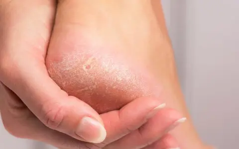Gros plan sur un talon sec et craquelé, montrant des crevasses. Une main touche la peau pour illustrer comment soigner les crevasses.
