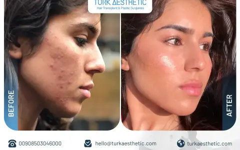 Prima e dopo un trattamento co2 laser viso per acne e imperfezioni. Pelle visibilmente più liscia e luminosa.