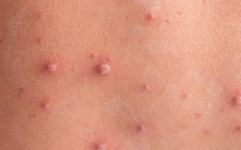 Skóra dziecka pokryta licznymi, czerwonymi krostkami i pęcherzykami, charakterystycznymi dla ospy.