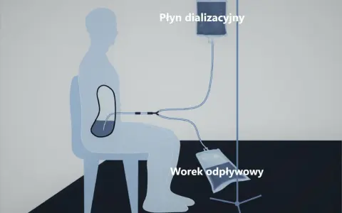 Schemat dializy otrzewnowej: cewnik Tenckhoffa w jamie otrzewnej pacjenta, podłączony do worka z płynem dializacyjnym i worka odpływowego.