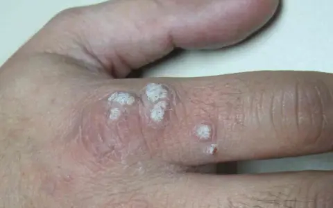 Verrugas en la mano, con aspecto escamoso y blanquecino. La diferencia entre verruga y condiloma es importante para el diagnóstico.