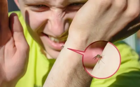 Bąble jak po ugryzieniu komara alergia – objawy i skuteczne leczenie