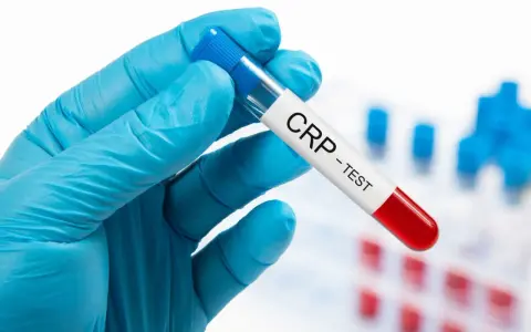 Ręka w niebieskiej rękawiczce trzyma probówkę z napisem "CRP - TEST". Badanie CRP pomaga ocenić stan zapalny w organizmie.