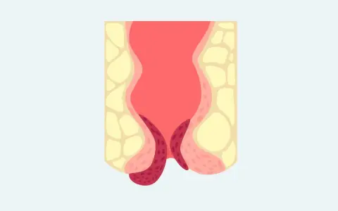 Illustration av ändtarmen med synliga hemorrojder. Hur vet man om man har hemorrojder? Blödning eller klåda kan vara tecken.