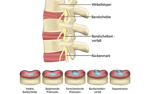 Illustration zeigt Wirbelkörper und Bandscheiben. Unten sind Stadien von Bandscheibenvorfällen abgebildet, von intakt bis Sequestration.