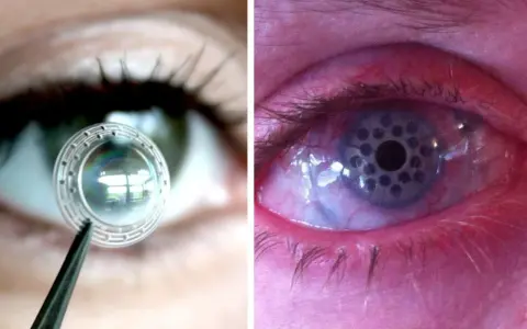 Lente per trapianto di retina in fase di applicazione e occhio con impianto retinico.