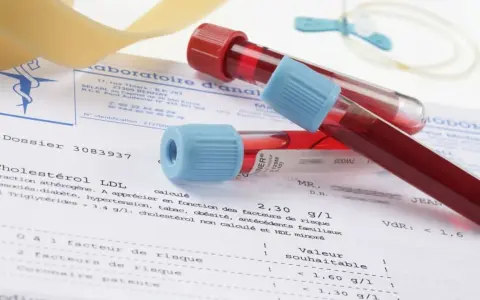 Próbki krwi w probówkach leżą na wynikach badań, gdzie widnieje m.in. poziom cholesterolu LDL. Wyniki mogą wskazywać na potrzebę monitorowania białka c reaktywnego.