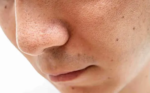 Gros plan sur un nez et une bouche, montrant des pores dilatés et quelques points noirs sur le visage.