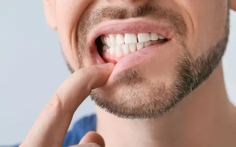 Mężczyzna bada palcem diastemę, widoczną przerwę między przednimi zębami.