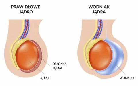 Porównanie prawidłowego jądra z jądrem dotkniętym wodniakiem. Wodniak jądra to nagromadzenie płynu.