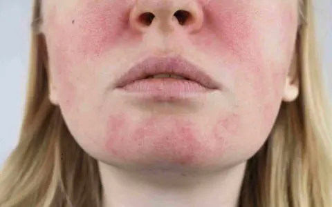 Une tache rouge sur le visage, près des lèvres et des joues, suggère une irritation cutanée.