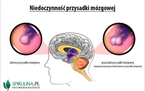 Mgła mózgowa, lęk, depresja? To może być gruczolak przysadki