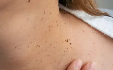 Primer plano de la piel del cuello con numerosas verrugas y lunares. Una mano toca suavemente la piel.
