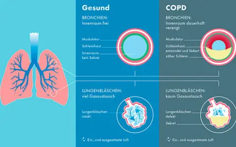 Vergleich gesunder Lungen mit COPD: Verengte Bronchien und defekte Lungenbläschen bei COPD erschweren den Gasaustausch.