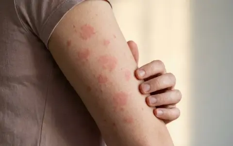 Arm mit roten Flecken auf der Haut, die auf eine allergische Reaktion oder Hautirritation hindeuten.