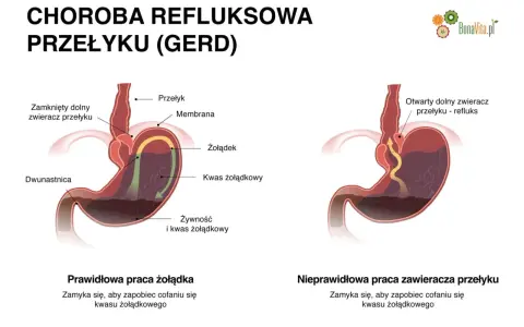 Objawy refluksu u dorosłych: Nie tylko zgaga! Kiedy iść do lekarza?