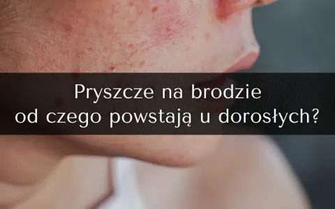 Pryszcze na brodzie: Jak się ich pozbyć? Kompletny poradnik ekspertki