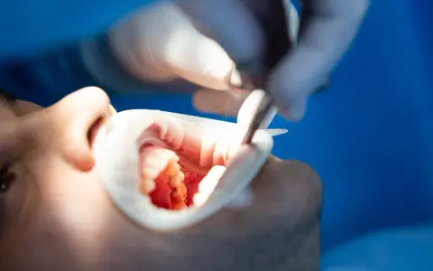 Dentysta wykonuje leczenie kanałowe zęba, używając narzędzi do precyzyjnej pracy w jamie ustnej pacjenta.