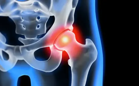 Coxarthrose Symptome: So erkennen Sie die schmerzhaften Anzeichen