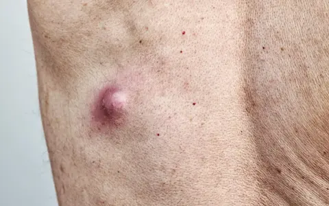 Widoczne grudki perliste u kobiet, jedna z nich jest zaczerwieniona i lekko opuchnięta, otoczona drobnymi czerwonymi kropkami na skórze.