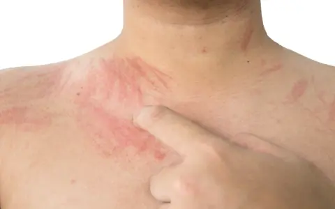 Czerwone pręgi na skórze, wynikające z dermografizmu. Co to jest? Reakcja na dotyk.