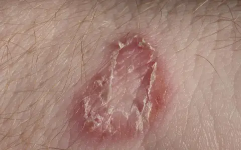 Zmiany skórne z zaczerwienieniem i łuszczącym się naskórkiem, wskazujące na grzybicę skóry.