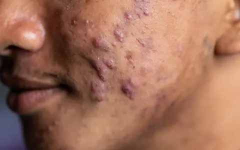 Gros plan sur une peau marquée par de nombreux boutons d'acné, dont un acné nodule particulièrement visible.