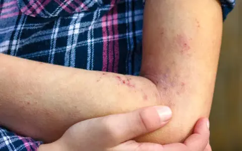 Wysypka jak ugryzienie komara u dziecka? Pokrzywka, alergia, Skeeter