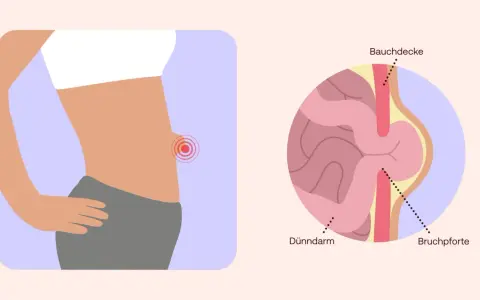 Illustration zeigt einen Bauch mit einem roten Schmerzpunkt und eine Nahaufnahme eines Nabelbruchs, der Dünndarm durch die Bauchdecke drückt. Nabelbruch Symptome.