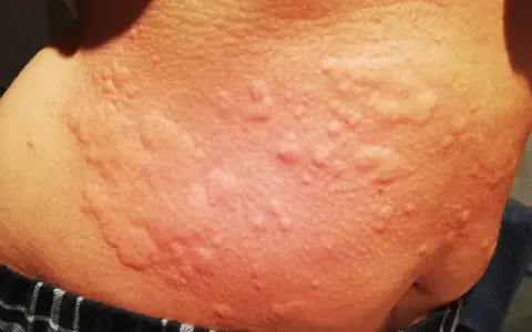 Piel con erupciones rojas y elevadas, posibles síntomas de ácaros en la cama.