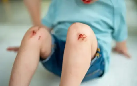 Dziecko z otartymi kolanami po upadku. Ważne jest, by pamiętać o szczepionce na tężec, która chroni przed groźnymi infekcjami.