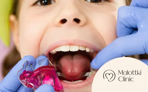 Uśmiechnięte dziecko z różową płytką Hawleya w ustach, przygotowywaną przez dentystę w rękawiczkach.