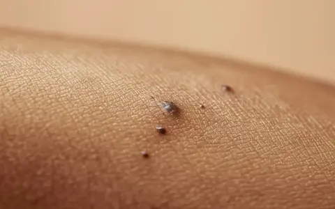 Zbliżenie na skórę z kilkoma ciemnymi znamionami. Jedno z nich, większe, przypomina czerniak - czarna kropka pod skórą.
