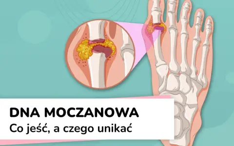 Dna moczanowa: powiększony staw palucha z kryształkami moczanowymi. Wysoki kwas moczowy może prowadzić do bólu.