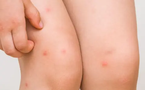 Piel de niño con pequeños bultos rojos, indicativos de foliculitis en las piernas.